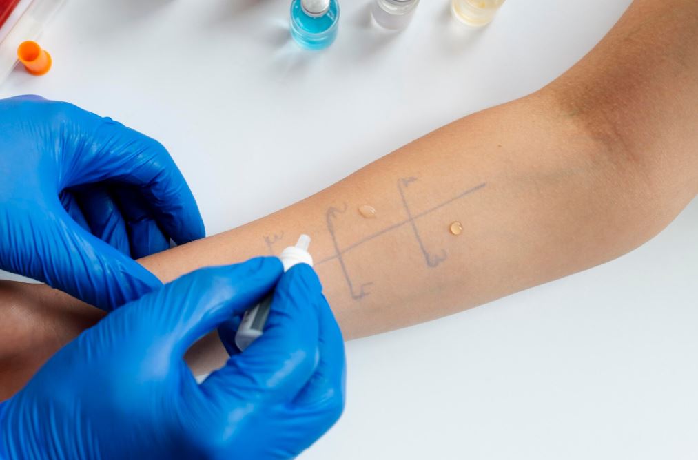 Allerji Testi (Prick) 