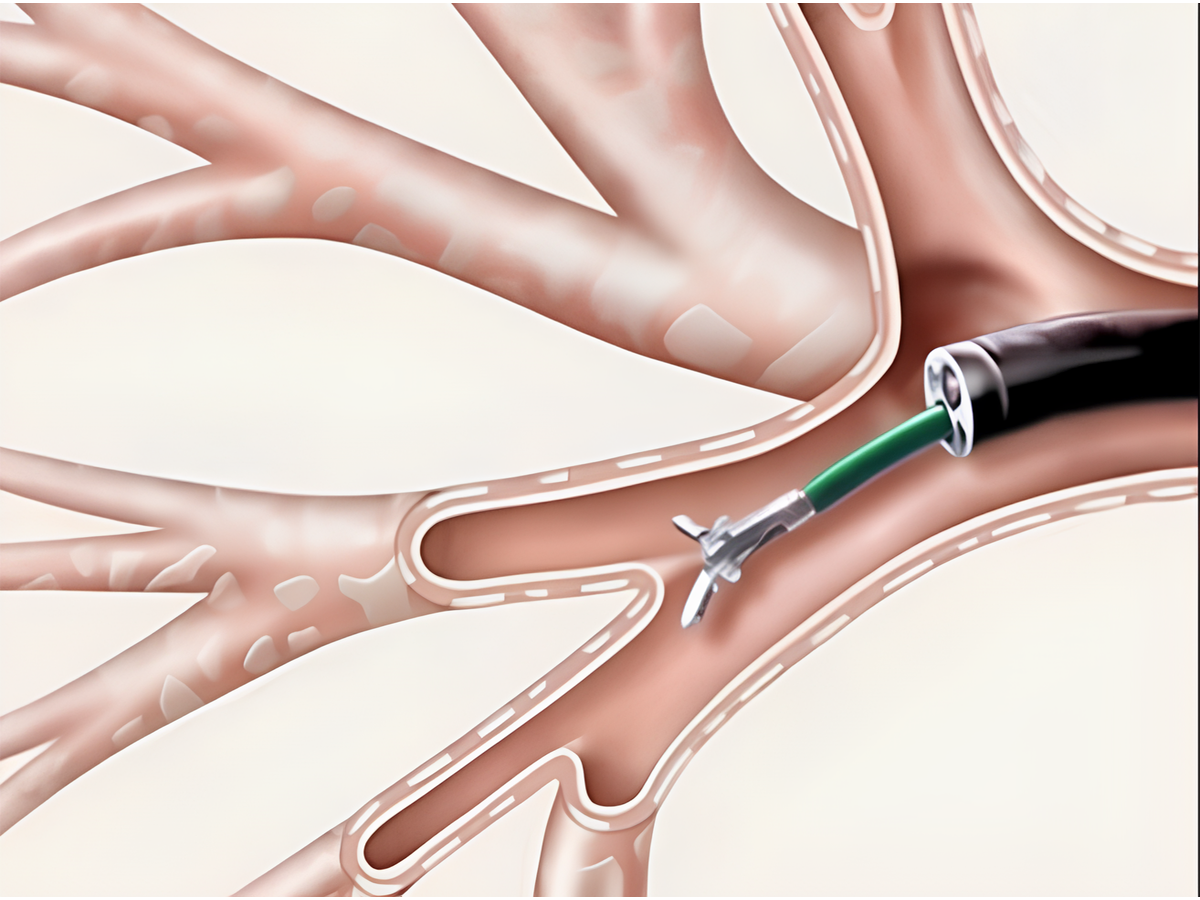 Bronkoskopi (FOB: Fiberoptik Bronkoskopi)