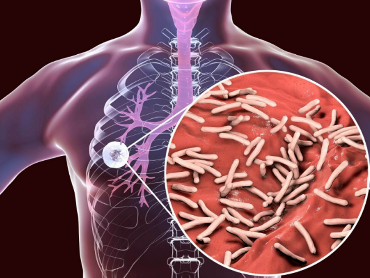 Akciğer Tüberkülozu Tanı ve Tedavisi